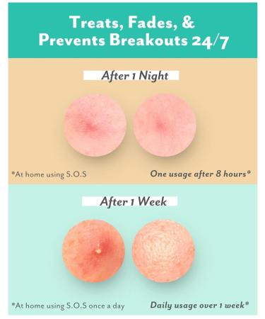 Patchology S.O.S. Overnight Acne Solution Gel-to-Patch Clarifying Liquid Patch 2.9% Sulfur 3% Niacinamide Dries Clear Fast Results Makeup Safe Pregnancy Safe Face & Body Use - Buy Online on GoSupps.com