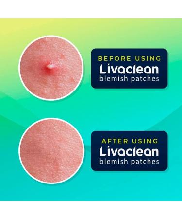 Livaclean (120 Count 3 Pack) Mix of Regular Tea and S.Acid Hydrocolloid Patch Stickers Face Absorbing Cover Face Patches Hydrocolloid Bandages 3 Pack - 120 Count - Buy Online on GoSupps.com