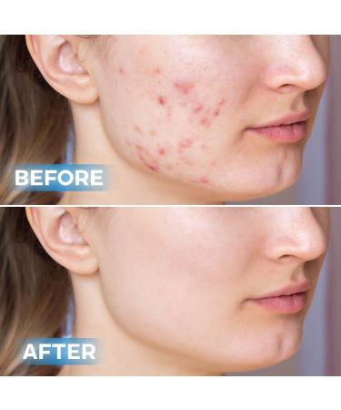 Buy Eczema Gel - Fast Healing Centella Aloe Vera Nano Silver for Itchy Skin Paraben-Free Reduces Rashes Scars & Dark Spots - Soremax Nature + Liver Supplement - Buy Online on GoSupps.com