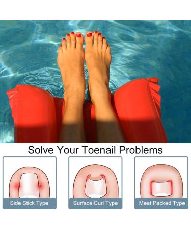 Foot Nail Correctors Corrector Strips for Ingrown Nails 50 Plasters for Toenails Toenail Correction Correction Kit for Thick Plastic Nails - Buy Online on GoSupps.com