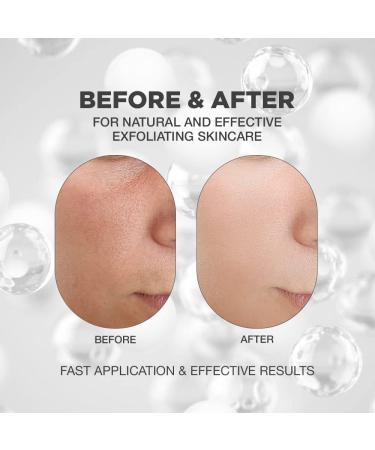 AHA BHA Exfoliant for Face - Peeling Solution with Salicylic Acid Glycolic Acid & Hyaluronic Acid | Natural Skin Rejuvenator | All Skin Types | 1.69 fl oz - Buy Online on GoSupps.com