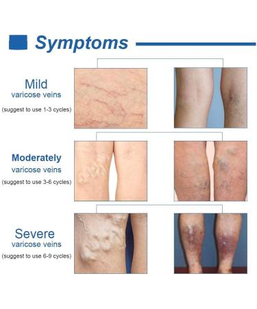 Varicose & Spider Veins Cream for Legs - Improve Blood Circulation, Varicose Care Ointment (50g) - Buy Online on GoSupps.com