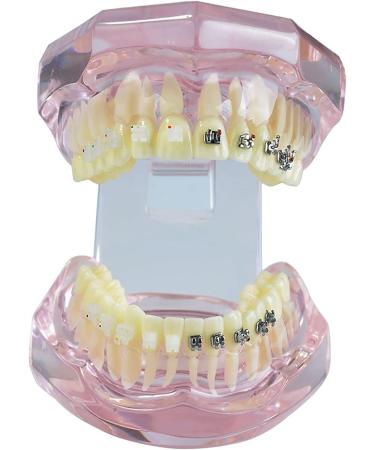 Buy Liusu Children's Tooth Theory Dental Model - Transparent Implant & Orthodontic Demo Model with Self-Ligating Clips | International Shipping Available - Buy Online on GoSupps.com