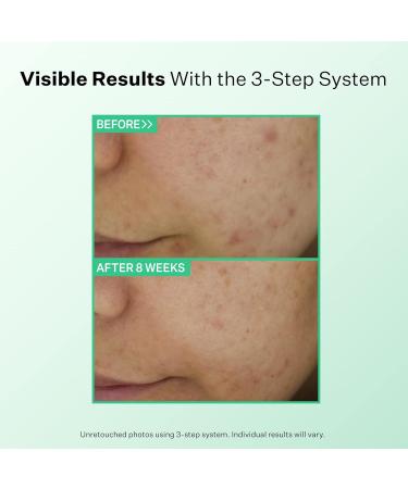 StriVectin Multi Action Clear Acne Treatment Lotion | Clearer Smoother Skin - 1.7 oz - Buy Online on GoSupps.com