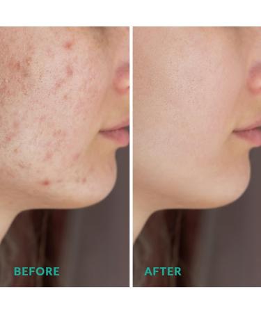 Organic Dead Sea Mud Mask - Premium Spa Quality Pore Minimizer for Acne & Oily Skin - 8.8 oz Skin Tightening Formula for Men & Women - Healthier Complexion - Buy Online on GoSupps.com