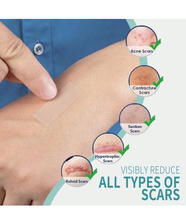 Silicone Scar Sheets 4 Pack for Surgery Scars Treatment - 5.7x1.57 Inch Tape Strips for Keloid, C-Section, Tummy Tuck, Stretch Marks - Surgical Scar Healing Cream Gel Patch Pad - Buy Online on GoSupps.com