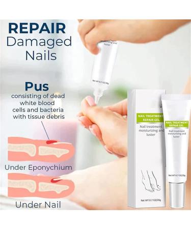 DUBUSH 2023 Removal Paronychia Gel Nail Nail Treatment Repair Gel Nail Repair Cream Anti Paronychia Relief Cream for Damaged Discolored Thick Nails 2 pieces - Buy Online on GoSupps.com