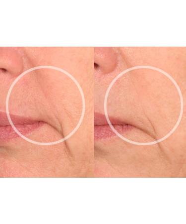 SiO LipLift Beauty Patches - Overnight Wrinkle Reducer for Lips & Smile | Clinically Tested Reusable 4-Week Supply - Shop Now - Buy Online on GoSupps.com