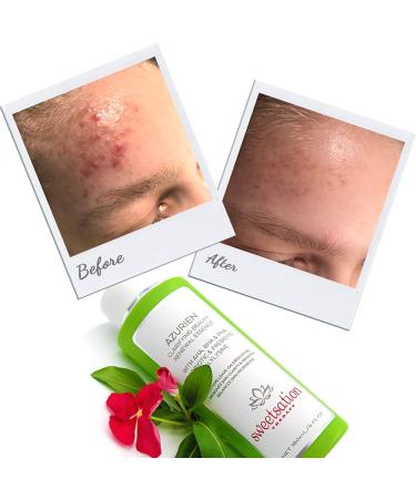 Sweetsation Therapy YUNASENCE AZURIEN Clarifying Beauty Renewal Essence 6oz - Exfoliate & Renew with 7 AHA+BHA+PHA - International Shipping Available - Buy Online on GoSupps.com