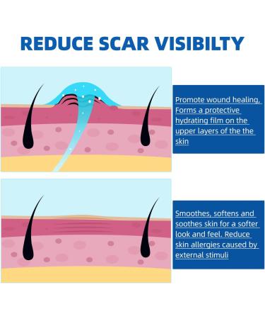 Scar Cream Gel for Face & Body - Effective Treatment for Surgical Scars, Stretch Marks, Acne, Keloids & Burns - 1.05 oz - Buy Online on GoSupps.com