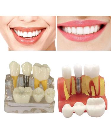 4x Dental Implant Teeth Model with Removable Crown - Crown & Bridge Dentist Training Tool for Patient Analysis | International Shipping - Buy Online on GoSupps.com