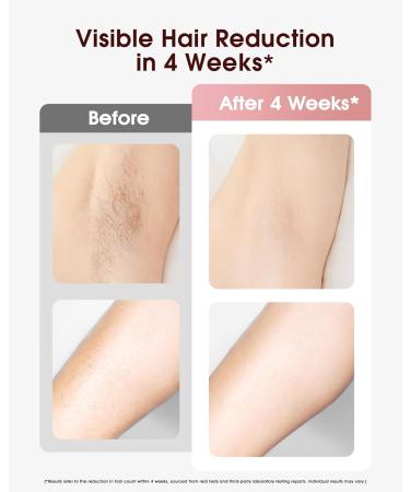LYSMOSKI Laser Hair Removal Device - Ice-Cooling IPL for Men & Women | Painless Long-Lasting At-Home Hair Remover for Arms Legs Bikini & Face - Rose Gold - Buy Online on GoSupps.com