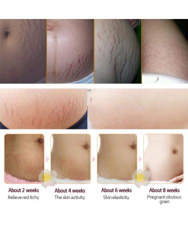 Stretch Marks & Scar Cream for Women | Body Repair Moisturizing Cream - 40g | Effective Post-Pregnancy Skin Care - Buy Online on GoSupps.com