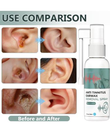 Hearing Restoration Spray Anti Tinnitus Earwax Removal Spray Earwax Cleaning Spray Tinnitus Spray for Ear (2PCS) - Buy Online on GoSupps.com