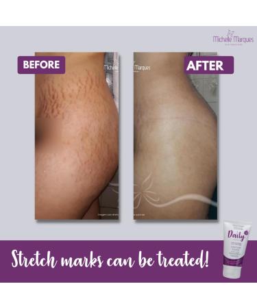 Daily Stretch Mark Treatment Brazilian Cream - Michelle Marques | Deep Hydration Reduces Stretch Marks Enhances Skin Elasticity (150g - Buy Online on GoSupps.com