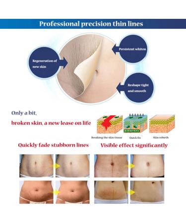 AICHUN BEAUTY Stretch Marks Cream with Snail Extract | Reduce Scars & Repair Damaged Skin | 120g - International Shipping Available - Buy Online on GoSupps.com