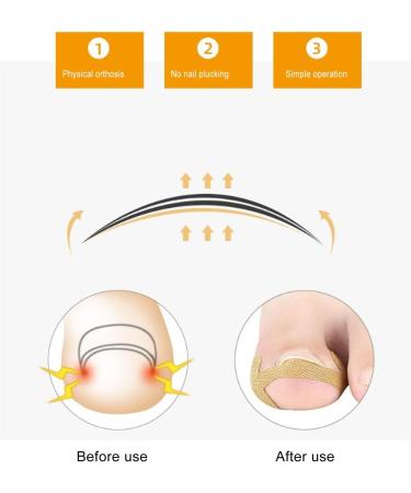 Toe Nail Growth Corrector Device Set Stainless Steel Ingrown Toenail Corrector Strips Kit for Pedicure - Buy Online on GoSupps.com