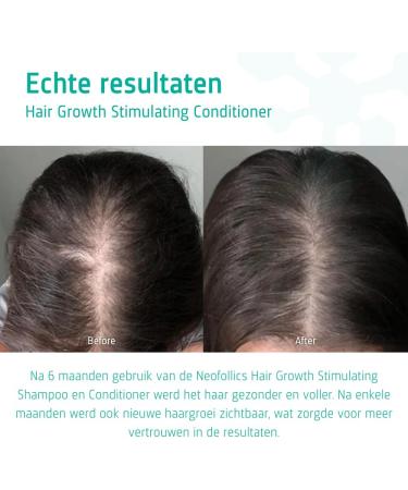 Neofollics Hair Growth Starter Kit Hair Growth Shampoo 100 ml + Hair Growth Conditioner 100 ml - Buy Online on GoSupps.com