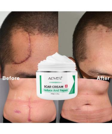Scar Removal Cream is used to treat scars and stretch marks old and new scars on the face and body (1.7 fl.oz) - Buy Online on GoSupps.com