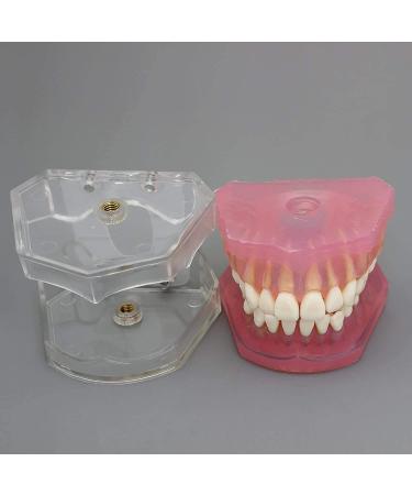 Samnuerly 28 Removable Teeth Dental Implant Model - Translucent Standard for Research & Teaching - Ideal for Removable Lower Jaw - Buy Online on GoSupps.com