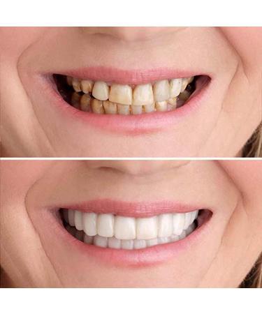 Buy Temporary Fake Teeth for Men & Women | Comfortable Cosmetic Denture Veneers for Upper & Lower Jaw - Regain Your Confident Smile - Buy Online on GoSupps.com