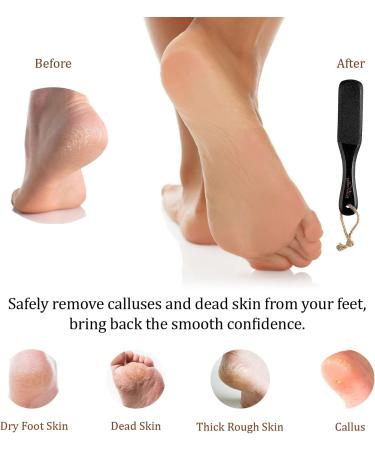 Pumice Stone Foot Scrubber with Handle - Callus Remover for Dry Dead Skin - Exfoliating Brush for Heels, Elbows & Hands - Buy Online on GoSupps.com