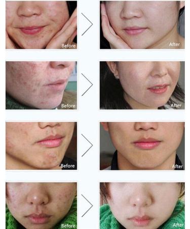 BIOAQUA Acne Scar Gel - Natural Blemish & Pimple Removal Cream for Oil Control & Pore Shrinking | International Shipping - Buy Online on GoSupps.com