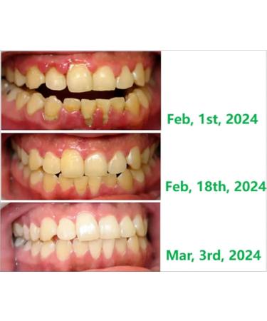 Convenient Gum Protection Pellets & Portable Toothpaste Tablets - Natural Travel Mouthwash Powder for Fresh Breath (Lemon) - Best Oral Care Solutions - Buy Online on GoSupps.com