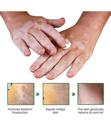 Vitiligo Care Set: Fix Revitalize Elixir & Soothing Moisturizer Cream - Reduce White Spots on Body - 2pcs - Buy Online on GoSupps.com