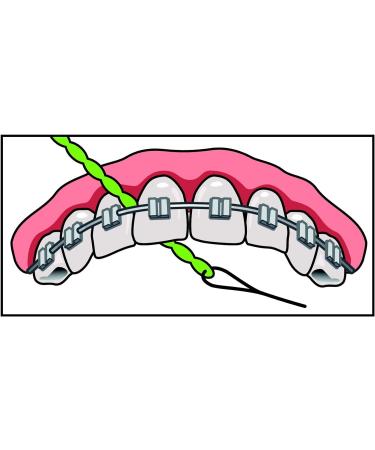 I Dontix Brace X-Floss Green - Easy-to-Use Dental Floss for Efficient Cleaning - Buy Online on GoSupps.com