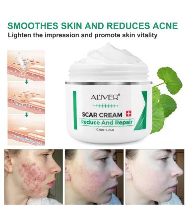 Scar Removal Cream for Old Scars, Stretch Marks & Burns - Natural Skin Repair for Acne Scars & Spots - Buy Online on GoSupps.com