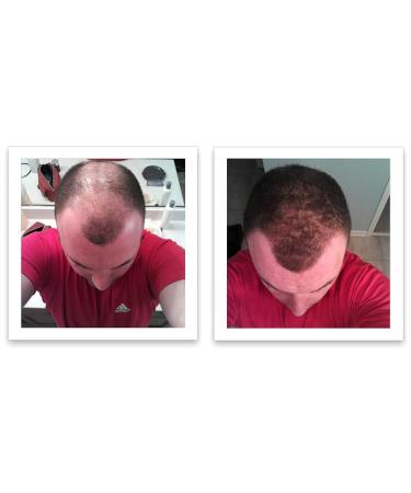 Caboki Hair Loss Concealer - All-Natural Hair Building Fiber for Fuller Hair. Cover Bald Spots and Thinning Areas. Dark Brown (30g) - Buy Online on GoSupps.com