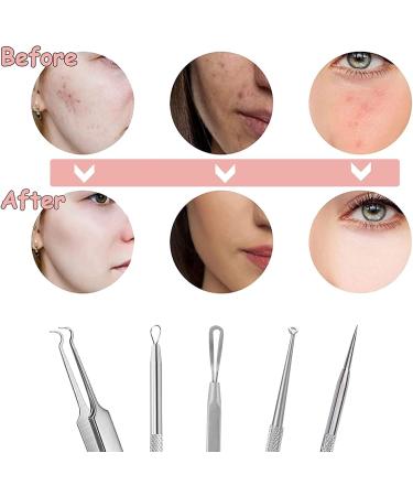 vgggrd Blackhead Remover Comedone Squeezer Set Professional Pimple Tool Tweezers Set with Metal Box Acne Whiteheads Blackhead Remover for All Skin Types - Buy Online on GoSupps.com