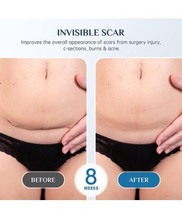Silicone Scar Remover Gel - Effective for Old & New Scars - 1.06 oz - 3PCS Set - Buy Online on GoSupps.com
