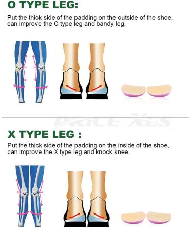 Orthopedic O/X Type Leg Corrective Heel Wedge & Inserts - Gel Pads for Bowlegs Knock Knees & Foot Alignment - International Shipping Available - Buy Online on GoSupps.com