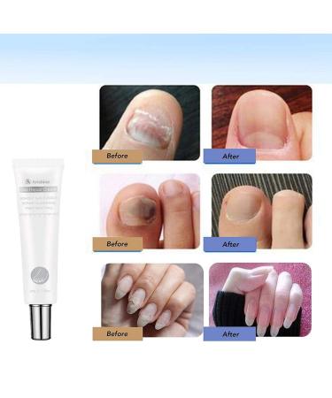 Maximum Strength Nail Fungus Treatment Cream - Antifungal Toenail & Fingernail Remover - Buy Online on GoSupps.com