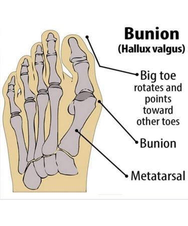 KEDUODUO Double Toe Corrector - Soft Bunion Straightener & Foot Care Socks for Alignment | Size L - Buy Online on GoSupps.com