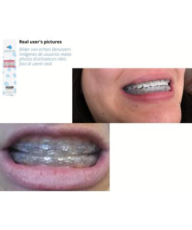 Buy Mouth Protection for Braces | Reusable Taste-Free Orthodontic Wax Alternative | Prevent Lip Wounds - Buy Online on GoSupps.com