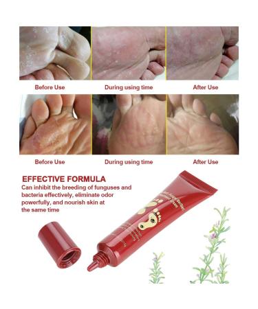 Crema para el Tratamiento de los Pies 15g | Hidratante Natural para Aliviar Hongos y Picaz n | Cuidado Efectivo para Plantas - Buy Online on GoSupps.com