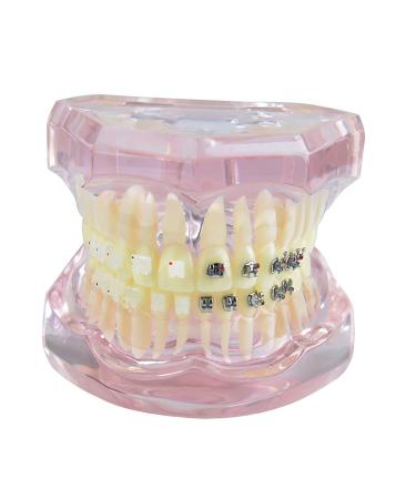Dental teeth model demo transparent dental implant disease teeth model with metal ceramic self-league bracket teeth of orthodontic retainer demonstration model
