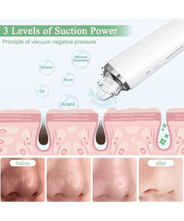 FDA Certified Blackhead Remover Pore Vacuum with WiFi Camera and 6 Suction Heads - Electric Facial Cleanser for Pimple Acne Extraction - White - Buy Online on GoSupps.com