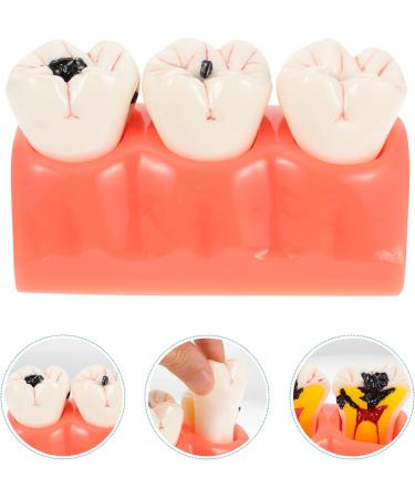 Ultechnovo Dental Recovery Tool Set - 2 Caries Tooth Models for Teaching & Demonstration | 12.5x7x6.5cm - Ideal for Dentistry Education - Buy Online on GoSupps.com