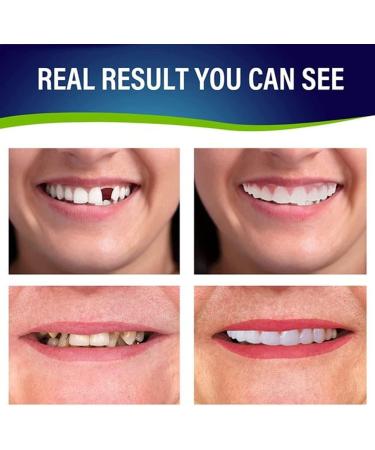 Flipped Warm Tooth Aperture - Comfortable Upper & Lower False Teeth for Perfect Smile | Flexible Braces - Buy Now! - Buy Online on GoSupps.com