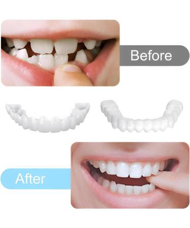 2 Pairs Adjustable Smile Support Can Quickly Restore Confident Smile (Upper and Lower Braces) - Buy Online on GoSupps.com
