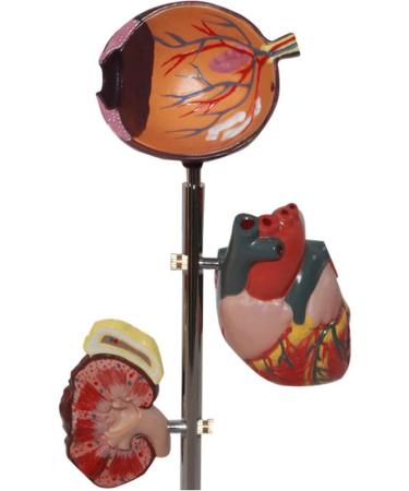 Comprehensive Human Diabetes Model: Intraocular Retinopathy Cataracts Coronary Heart Disease & More | Global Shipping Available - Buy Online on GoSupps.com