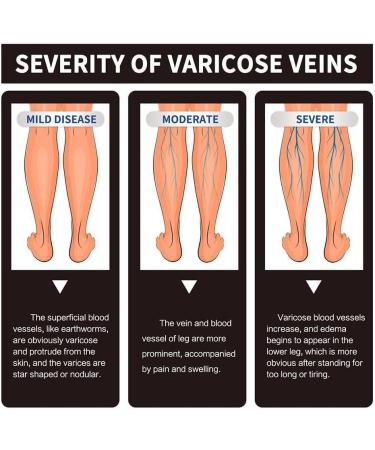 GXFCAI Marrony Oil for Varicose Veins | Effective Vein Treatment Spray for Legs | 10ml - 3 Boxes - Buy Online on GoSupps.com
