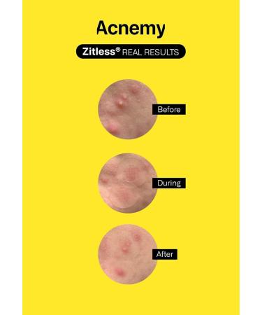 Zitless - 5 Microdart Patches for Early-Stage Pimples | Fast & Effective Acne Treatment - Buy Online on GoSupps.com