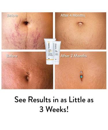 TriLASTIN-SR Intensive Stretch Mark Cream Bundle | Fast-Acting Remover with Accelerator | Hypoallergenic & Paraben-Free - Buy Online on GoSupps.com