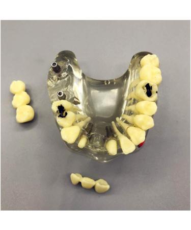 Fhuili teeth implant model-implant recovery model with removable chewing gum and prosthesis-section Half-Port Bridbild-Restauration model for study lessons a