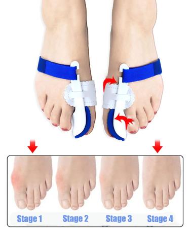 Alinzo Ballenzeh Orthopedic Correction for Women & Men | Pain Relief for Great Toe | Non-Surgical Blue Bale Rail - Buy Online on GoSupps.com
